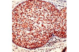 Human breast ca. (Cathepsin D antibody)