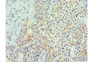 Immunohistochemistry of paraffin-embedded human breast cancer using ABIN7155972 at dilution of 1:100