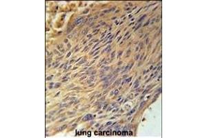 CPEB4 Antibody (N-term) (ABIN651815 and ABIN2840408) immunohistochemistry analysis in formalin fixed and paraffin embedded human lung carcinoma followed by peroxidase conjugation of the secondary antibody and DAB staining. (CPEB4 antibody  (N-Term))