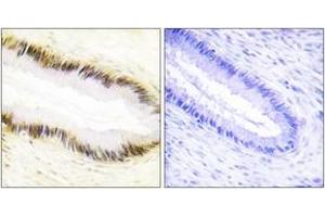 Immunohistochemistry analysis of paraffin-embedded human cervix carcinoma tissue, using NR2F6 Antibody. (NR2F6 antibody  (AA 11-60))