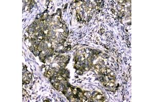 IHC testing of FFPE human breast cancer tissue with MYBPC3 antibody at 1ug/ml. (MYBPC3 antibody)