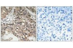 Immunohistochemistry analysis of paraffin-embedded human breast carcinoma tissue using MAP3K7 (Ab-187) antibody. (MAP3K7 antibody  (Thr187))