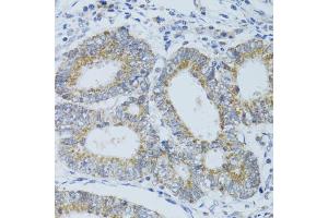 Immunohistochemistry of paraffin-embedded human colon carcinoma using DNAJC19 antibody (ABIN5972967) at dilution of 1/100 (40x lens).