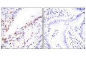 Immunohistochemistry analysis of paraffin-embedded human lung carcinoma tissue, using Ki67antibody. (Ki-67 antibody  (C-Term))