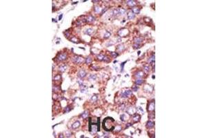Formalin-fixed and paraffin-embedded human cancer tissue reacted with the primary antibody, which was peroxidase-conjugated to the secondary antibody, followed by AEC staining. (TOLLIP antibody  (C-Term))