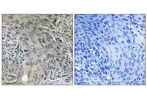 Immunohistochemistry analysis of paraffin-embedded human cervix carcinoma tissue using COPZ1 antibody. (COPZ1 antibody  (N-Term))