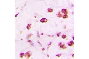 Immunohistochemical analysis of DLX5 staining in human lung cancer formalin fixed paraffin embedded tissue section. (DLX5 antibody  (Center))
