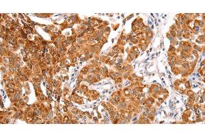 Immunohistochemistry of paraffin-embedded Human lung cancer using TRAF5 Polyclonal Antibody at dilution of 1:30 (TRAF5 antibody)