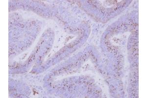 IHC-P Image Immunohistochemical analysis of paraffin-embedded human colon carcinoma, using INPP5F, antibody at 1:500 dilution. (INPP5F antibody)