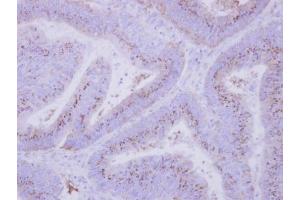 IHC-P Image Immunohistochemical analysis of paraffin-embedded human colon carcinoma, using INPP5F, antibody at 1:500 dilution.