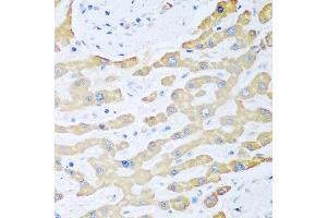 Immunohistochemistry of paraffin-embedded human liver cancer using FDXR antibody at dilution of 1:100 (40x lens).