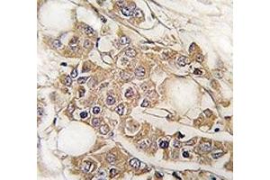 IHC analysis of FFPE human breast carcinoma tissue stained with Vimentin antibody (Vimentin antibody  (AA 63-90))
