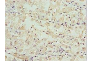 Immunohistochemistry of paraffin-embedded human gastric cancer using ABIN7162247 at dilution of 1:100 (OPA3 antibody  (AA 25-179))