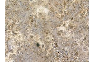 ABIN6255084 and ABIN6267182 at 1/100 staining human melanoma by IHC-P. (SMAD1 antibody  (pSer206))