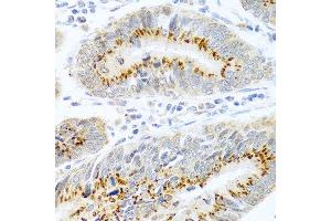 Immunohistochemistry of paraffin-embedded human colon carcinoma using FAM3B antibody at dilution of 1:100 (40x lens).