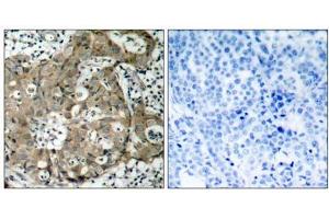 Immunohistochemical analysis of paraffin-embedded human breast carcinoma tissue using FKHR (Ab-319) antibody (E021161). (FOXO1 antibody)