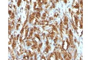 IHC testing of FFPE rhabdomyosarcoma with Muscle Actin antibody