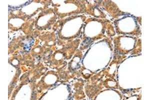 The image on the left is immunohistochemistry of paraffin-embedded Human thyroid cancer tissue using ABIN7130819(RASAL1 Antibody) at dilution 1/20, on the right is treated with fusion protein. (RASAL1 antibody)