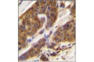 Immunohistochemistry analysis in Formalin Fixed, Paraffin Embedded Human bladder carcinoma stained with CFD Antibody (N-term) followed by peroxidase conjugation of the secondary antibody and DAB staining. (Adipsin antibody  (N-Term))
