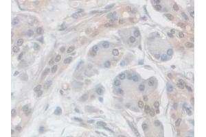 IHC-P analysis of Human Pancreatic cancer Tissue, with DAB staining. (VPS37A antibody  (AA 1-397))