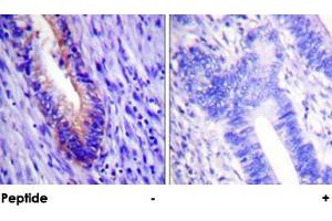 Immunohistochemical analysis of paraffin-embedded human colon carcinoma tissue using EIF4G1 polyclonal antibody .