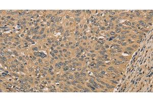 Immunohistochemistry of paraffin-embedded Human cervical cancer tissue using PRDM14 Polyclonal Antibody at dilution 1:30 (PRDM14 antibody)