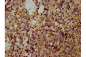 IHC image of ABIN7175671 diluted at 1:200 and staining in paraffin-embedded human ovarian cancer performed on a Leica BondTM system. (WFDC2 antibody  (AA 31-124))