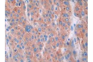 IHC-P analysis of Human Liver cancer Tissue, with DAB staining. (CUBN antibody  (AA 3511-3623))