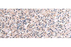 Immunohistochemistry of paraffin-embedded Human liver cancer tissue using RNF115 Polyclonal Antibody at dilution of 1:45(x200) (RNF115 antibody)
