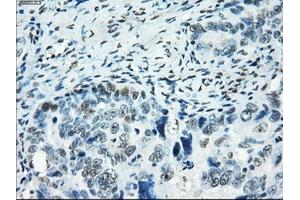 Immunohistochemical staining of paraffin-embedded colon tissue using anti-SATB1mouse monoclonal antibody. (SATB1 antibody)