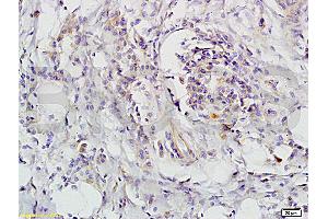 Formalin-fixed and paraffin-embedded human colon carcinoma labeled with Rabbit Anti-CD118 Polyclonal Antibody, unconjugated  (ABIN686827)  1: 200 followed by incubation with conjugated secondary antibody and DAB staining (LIFR antibody  (AA 451-580))