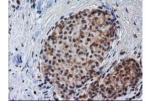 Immunohistochemical staining of paraffin-embedded Adenocarcinoma of Human breast tissue using anti-NHEJ1 mouse monoclonal antibody. (NHEJ1 antibody)