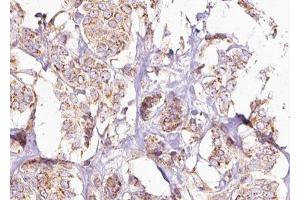 ABIN6275245 at 1/100 staining Human breast cancer tissue by IHC-P. (MRPL49 antibody  (Internal Region))