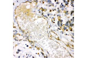 Anti- HMOX1 antibody, IHC(P) IHC(P): Human Lung Cancer Tissue (HMOX1 antibody  (AA 1-288))
