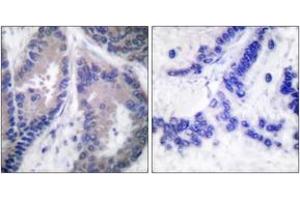 Immunohistochemistry analysis of paraffin-embedded human lung carcinoma tissue, using Collagen alpha1 XVIII Antibody. (COL18A1 antibody  (AA 1301-1350))