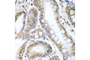 Immunohistochemistry of paraffin-embedded human colon carcinoma using TNFSF10 antibody (ABIN3023014, ABIN3023015, ABIN3023016 and ABIN6219347) at dilution of 1:200 (40x lens).