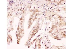 IHC-P: ATF1 antibody testing of human intestinal cancer tissue (AFT1 antibody  (AA 1-271))