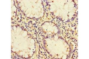 Immunohistochemistry of paraffin-embedded human colon cancer using ABIN7164149 at dilution of 1:100 (PCF11 antibody  (AA 409-604))