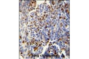 FOSL2 antibody (Center) (ABIN654925 and ABIN2844568) immunohistochemistry analysis in formalin fixed and paraffin embedded human lung carcinoma followed by peroxidase conjugation of the secondary antibody and DAB staining. (FOSL2 antibody  (AA 95-122))