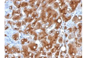 Formalin-fixed, paraffin-embedded human Hepatocellular Carcinoma stained with Serum Amyloid A Mouse Monoclonal Antibody (SAA/326). (SAA antibody)