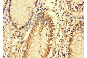 Immunohistochemistry of paraffin-embedded human colon cancer using ABIN7165398 at dilution of 1:100 (FAM135B antibody  (AA 801-1100))