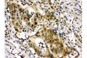 Anti- EIF6 Picoband antibody,IHC(P) IHC(P): Human Intestinal Cancer Tissue (EIF6 antibody  (AA 66-210))
