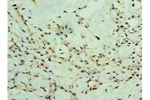 Immunohistochemistry of paraffin-embedded human breast cancer using ABIN7176056 at dilution of 1:100 (ZEB2 antibody  (AA 1050-1214))