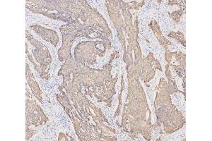 IHC analysis of Cytokeratin 19 using anti-Cytokeratin 19 antibody (ABIN3043288). (Cytokeratin 19 antibody  (C-Term))