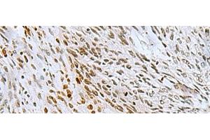 Immunohistochemistry of paraffin-embedded Human lung cancer tissue using CNOT7 Polyclonal Antibody at dilution of 1:55(x200) (CNOT7 antibody)