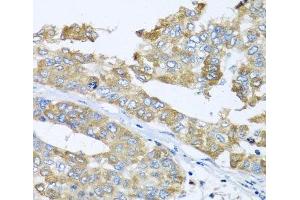 Immunohistochemistry of paraffin-embedded Human liver cancer using COQ7 Polyclonal Antibody at dilution of 1:100 (40x lens).