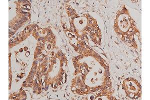 ABIN6268758 at 1/50 staining human colon cancer tissue sections by IHC-P. (CYP17A1 antibody  (Internal Region))