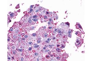 Anti-OPN5 antibody IHC of human Ovary, Carcinoma. (OPN5 antibody  (Transmembrane Domain))