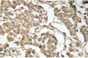 Immunohistochemistry (IHC) analyzes of p-eIF2alpha in paraffin-embedded human breast carcinoma tissue. (EIF2S1 antibody  (pSer51))