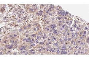 ABIN6276397 at 1/100 staining Human Melanoma tissue by IHC-P. (Interleukin 17a antibody  (Internal Region))
